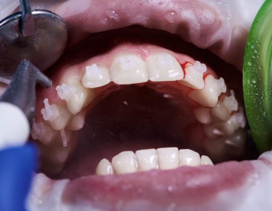Descoperă semnele care îți arată că ai nevoie de detartraj dentar